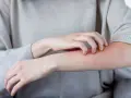 Dłoń drapiąca zaczerwienione ramię, objaw rumienia zakaźnego w ciąży.