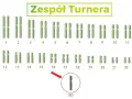 Kariotyp przedstawiający zespół Turnera, z zaznaczonym brakiem jednego chromosomu X (XO).