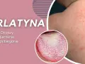 Szkarlatyna: wysypka na skórze i nalot na języku.