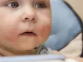 Urocze niemowlę z zaczerwienionymi policzkami, które mogą świadczyć o alergii u niemowlaka.