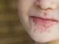 Zbliżenie na twarz dziecka z wysypką wokół ust i nosa.