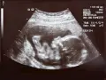 Badanie USG płodu w 2. lub 3. trymestrze ciąży.