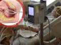 Ilustracja anatomiczna porodu kleszczowego obok kobiety w łóżku szpitalnym.