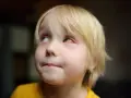 Mały chłopiec z blond włosami ma zaczerwienione, spuchnięte oko.
