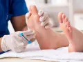 Lekarz w rękawiczkach bada stopę pacjenta młoteczkiem neurologicznym.