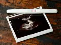 Test ciążowy z dwoma kreskami i zdjęcie USG. To początek pięknej podróży, 7 tydzień ciąży.