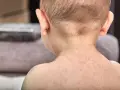 Plecy i kark niemowlęcia pokryte drobną, czerwoną wysypką.