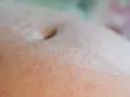 Skóra brzucha z drobnymi, czerwonymi krostkami i grudkami, typowa dla wysypki w ciąży.