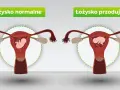 Porównanie: łożysko normalne vs łożysko przodujące. Na obrazku widać macicę z płodem. Po prawej łożysko przodujące, które może blokować szyjkę macicy.