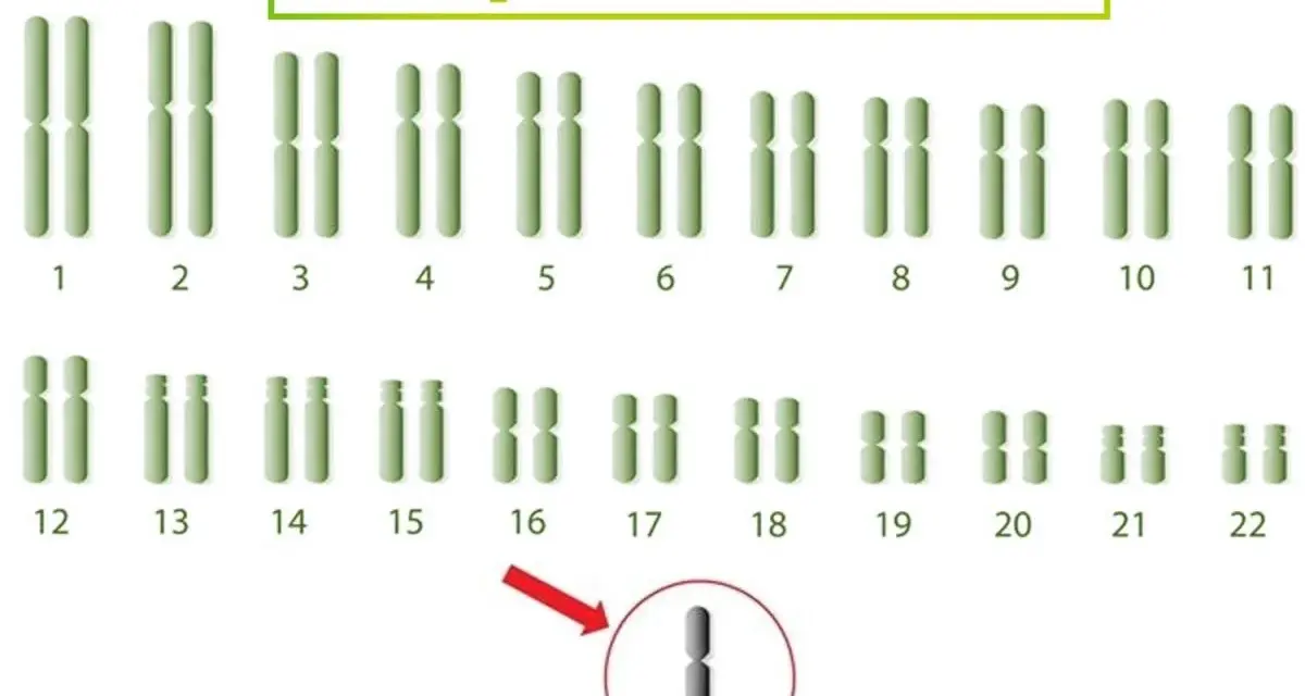 Kariotyp przedstawiający zespół Turnera, z zaznaczonym brakiem jednego chromosomu X (XO).