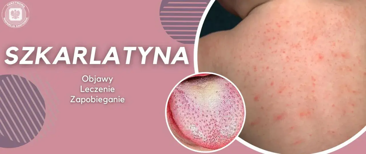 Szkarlatyna: wysypka na skórze i nalot na języku.