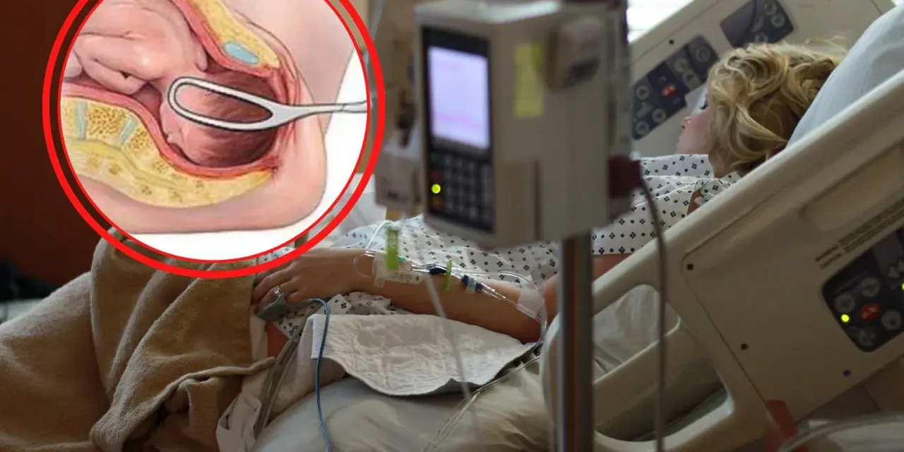 Ilustracja anatomiczna porodu kleszczowego obok kobiety w łóżku szpitalnym.