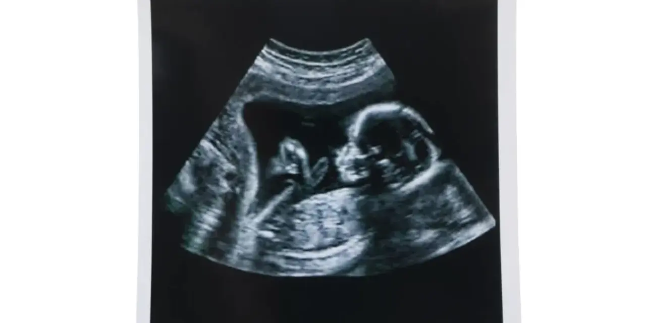 USG płodu z widocznym profilem dziecka. Przezierność karkowa normy, co jest dobrym znakiem.