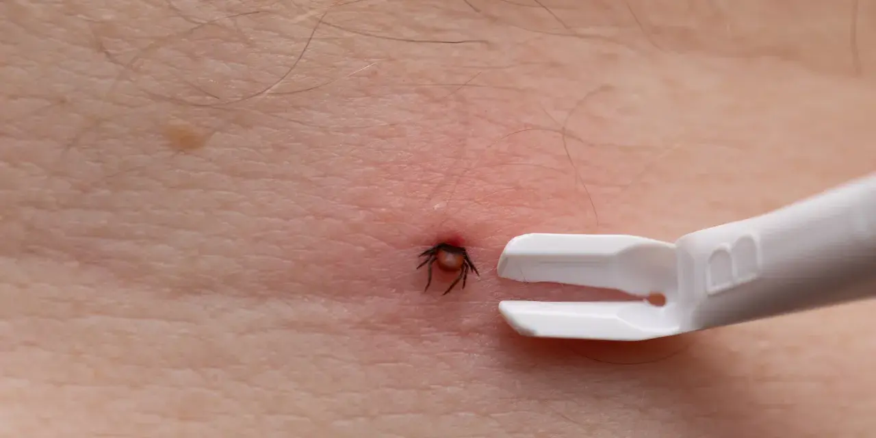 Zbliżenie na ludzką skórę z czerwonym zaczerwienieniem wokół wbitego kleszcza. Obok widoczny biały przyrząd do usuwania kleszczy.