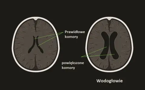 Wodogłowie u niemowląt: objawy, leczenie i co robić, gdy podejrzewasz?