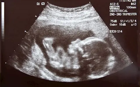 Badanie USG płodu w 2. lub 3. trymestrze ciąży.