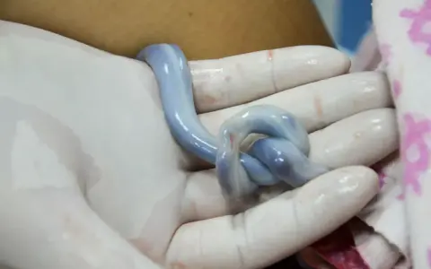 Dłoń w białej rękawiczce trzyma niebieski, skręcony sznur pępowiny.