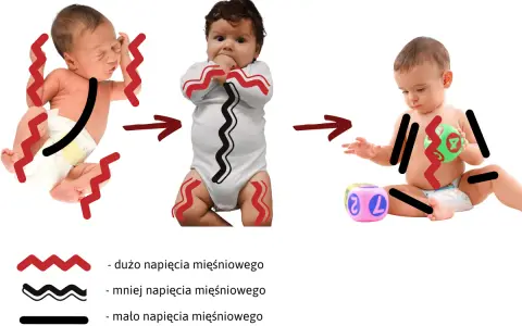 Obrazek pokazuje, jak wzmożone napięcie mięśniowe u niemowląt mija z czasem, od noworodka z mocnym napięciem do starszego dziecka z mniejszym.