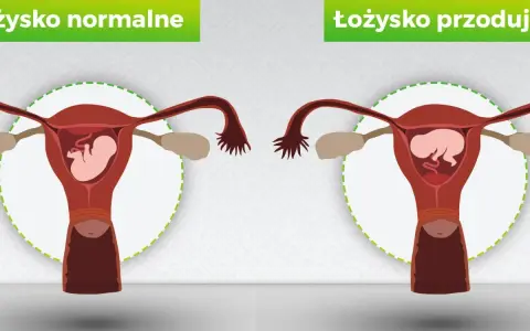 Porównanie: łożysko normalne vs łożysko przodujące. Na obrazku widać macicę z płodem. Po prawej łożysko przodujące, które może blokować szyjkę macicy.