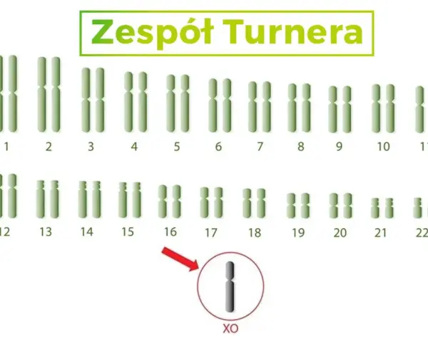 Kariotyp przedstawiający zespół Turnera, z zaznaczonym brakiem jednego chromosomu X (XO).