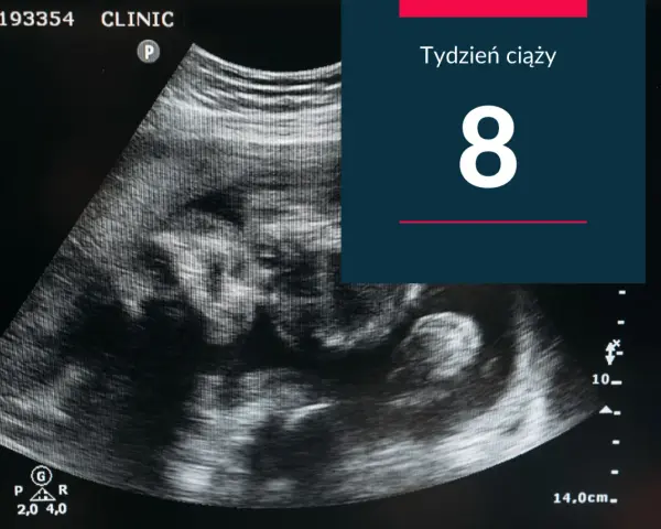 USG pokazuje zarodek w 8 tygodniu ciąży. Rozwija się nowe życie.