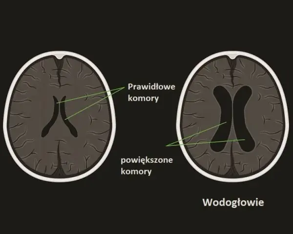 Wodogłowie u niemowląt: objawy, leczenie i co robić, gdy podejrzewasz?