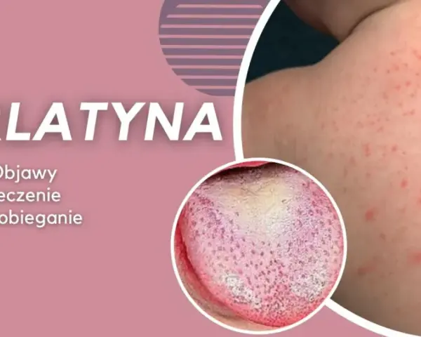 Szkarlatyna: wysypka na skórze i nalot na języku.