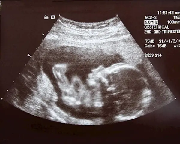 Badanie USG płodu w 2. lub 3. trymestrze ciąży.