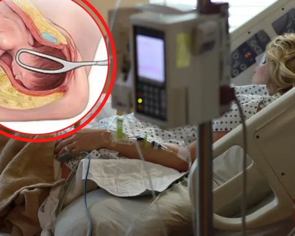 Ilustracja anatomiczna porodu kleszczowego obok kobiety w łóżku szpitalnym.