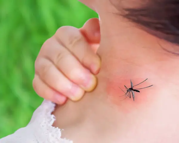 Dziecko drapie zaczerwienione miejsce na szyi po ukąszeniu komara. Rumień jest widoczny.