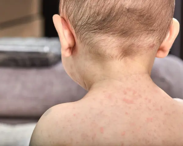 Plecy i kark niemowlęcia pokryte drobną, czerwoną wysypką.