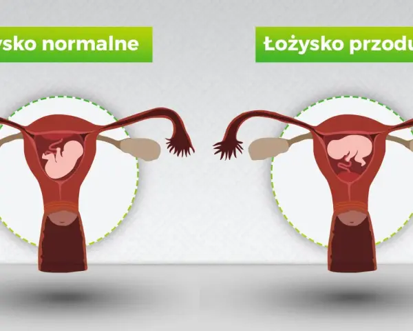 Porównanie: łożysko normalne vs łożysko przodujące. Na obrazku widać macicę z płodem. Po prawej łożysko przodujące, które może blokować szyjkę macicy.