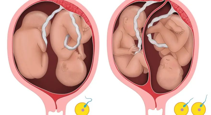 Dwa płody w macicy, połączone pępowinami. Ilustracja pokazuje rozwój bliźniaków dwujajowych.