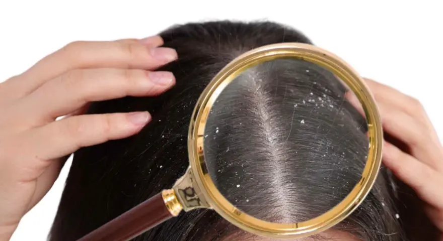 Zbliżenie na skórę głowy z widocznymi białymi płatkami łupieżu pod lupą. Dłonie delikatnie rozsuwają włosy, ukazując problem.