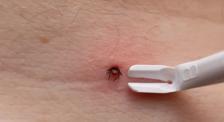 Zbliżenie na ludzką skórę z czerwonym zaczerwienieniem wokół wbitego kleszcza. Obok widoczny biały przyrząd do usuwania kleszczy.