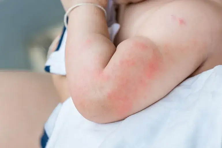 dziecko z wysypką alergia na mleko