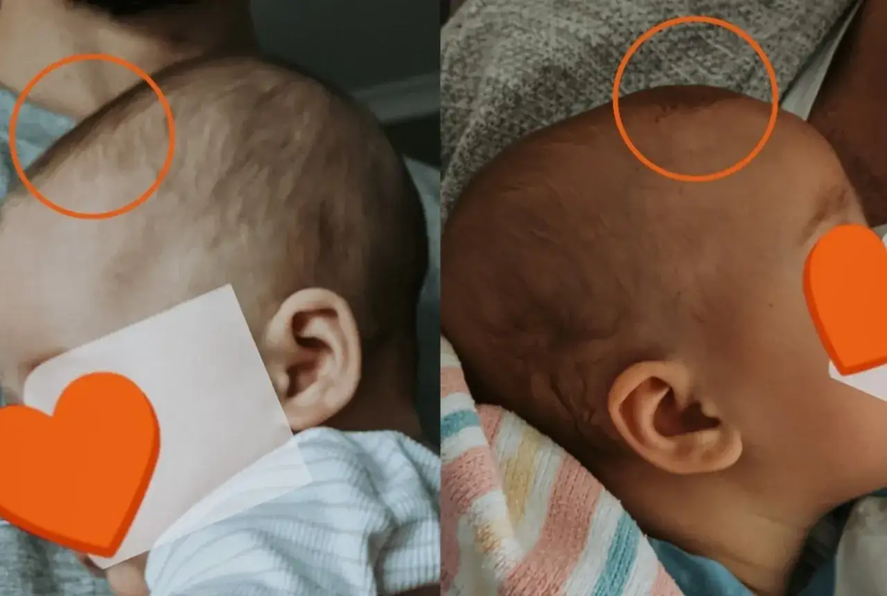 Dwa ujęcia główki niemowlaka. Na lewym widać wyraźne zapadnięte ciemiączko, na prawym jest ono mniej widoczne.