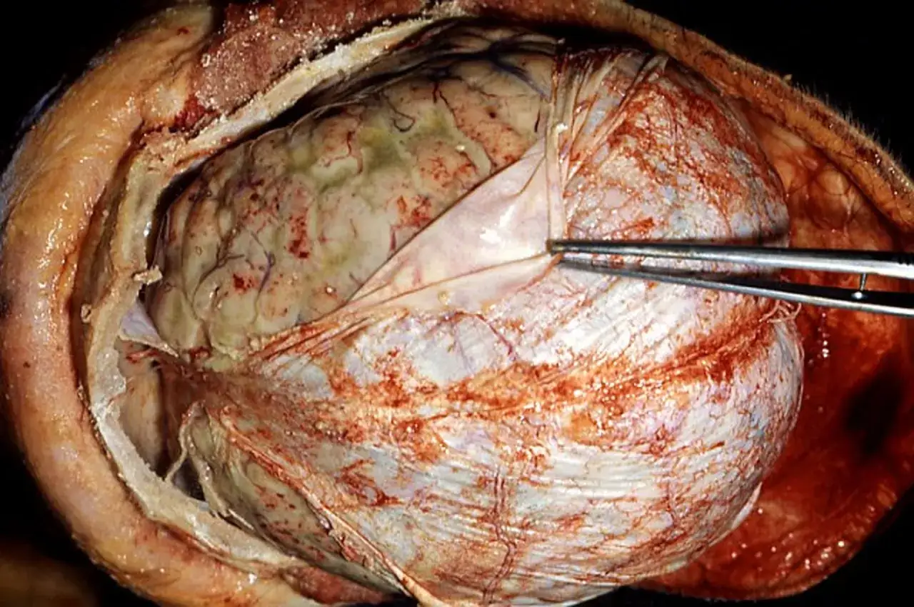Widoczne zapalenie opon mózgowych u dzieci. Tkanki mózgu i opon są obrzęknięte, zaczerwienione, z widocznymi ogniskami zapalnymi.