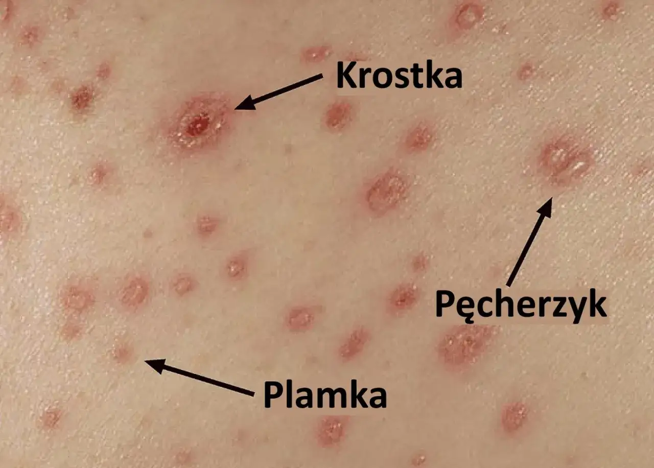 Zmiany skórne: plamki, krostki i pęcherzyki. Czy z ospą można wychodzić na dwór? Zmiany skórne wskazują na ospę.