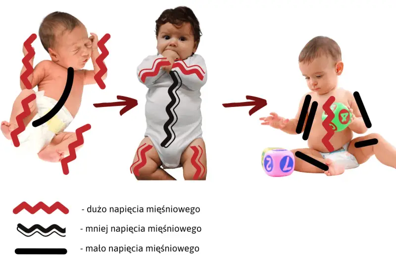 Obrazek pokazuje, jak wzmożone napięcie mięśniowe u niemowląt mija z czasem, od noworodka z mocnym napięciem do starszego dziecka z mniejszym.